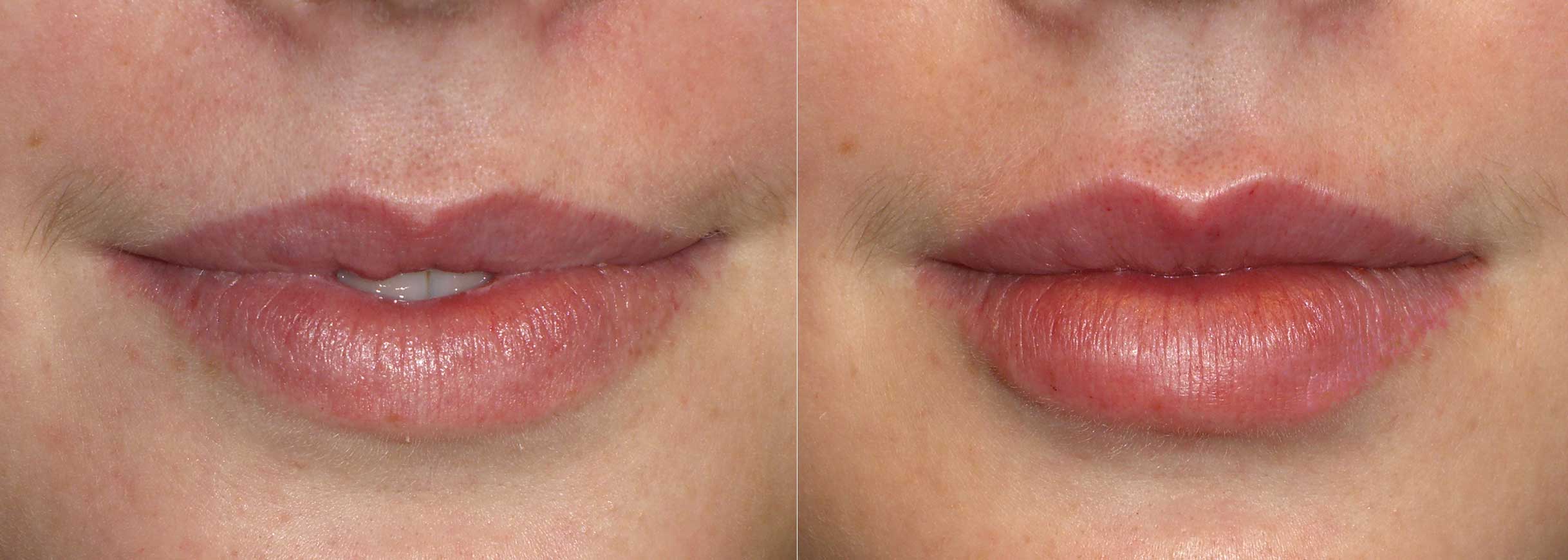Lip Augmentation Worth It? Reviews, Cost, Pictures - RealSelf