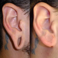 Surface Medial Spas Earlobe Repair - Before and After Patient 1
