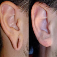 Surface Medial Spas Earlobe Repair - Before and After Patient 2