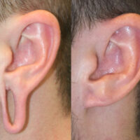Surface Medial Spas Earlobe Repair - Before and After Patient 4