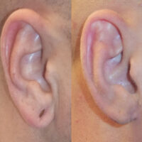 Surface Medial Spas Earlobe Repair - Before and After Patient 5