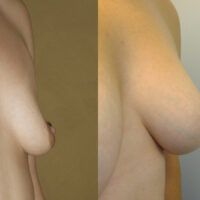 Natural Breast Augmentation - Client Before and After 1