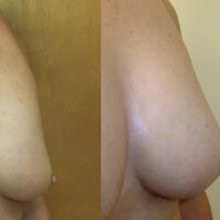 Natural Breast Augmentation - Client Before and After 2