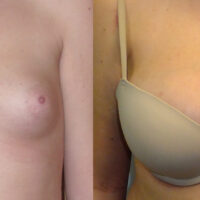 Natural Breast Augmentation - Client Before and After 3