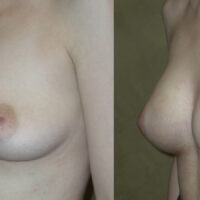 Natural Breast Augmentation - Client Before and After 4