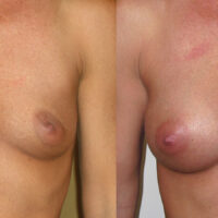 Natural Breast Augmentation - Client Before and After 6