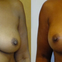 Natural Breast Augmentation - Client Before and After 7