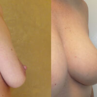 Natural Breast Augmentation - Client Before and After 9