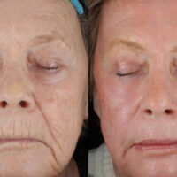 Surface Medical Spas CO2 Fractional Laser - Before and After client 1
