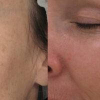 Surface Medical Spas CO2 Fractional Laser - Before and After client 1