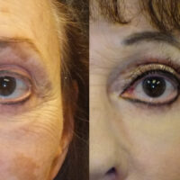 Surface Medical Spas CO2 Fractional Laser - Before and After client 3