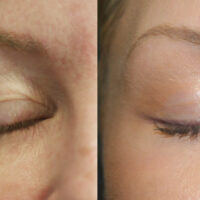 Surface Medical Spas CO2 Fractional Laser - Before and After client 4