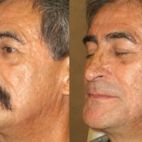 Surface Medical Spas Chemical Peel - Before and After client 1