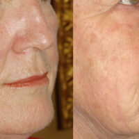 Surface Medical Spas Chemical Peel - Before and After client 1