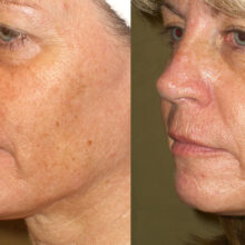 Surface Medical Spas Clear2 Fotofacial - Before and After Client 1