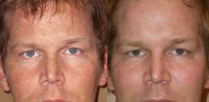 Surface Medical Spas Clear2 Fotofacial - Before and After Client 2