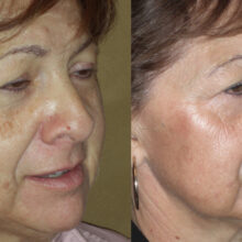 Surface Medical Spas Clear2 Fotofacial - Before and After Client 3