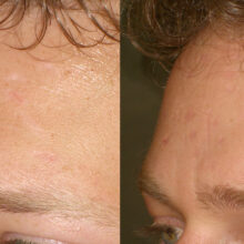 Surface Medical Spas Clear2 Fotofacial - Before and After Client 4