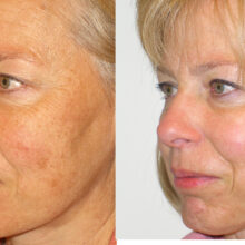 Surface Medical Spas Clear2 Fotofacial - Before and After Client 5