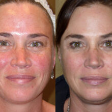 Surface Medical Spas Clear2 Fotofacial - Before and After Client 6