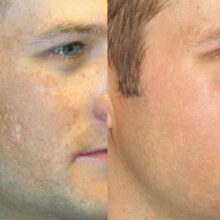 Surface Medical Spas Clear2 Fotofacial - Before and After Client 7