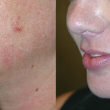 Surface Medical Spas Clear2 Fotofacial - Before and After Client 8