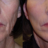 Encore Facelift - Before and After Client 1