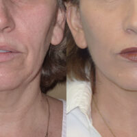 Encore Facelift - Before and After Client 10