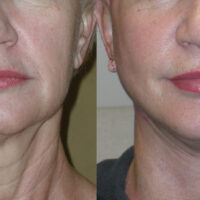 Encore Facelift - Before and After Client 11