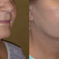 Encore Facelift - Before and After Client 12