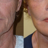 Encore Facelift - Before and After Client 2