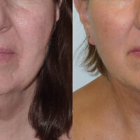 Encore Facelift - Before and After Client 3