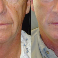 Encore Facelift - Before and After Client 4