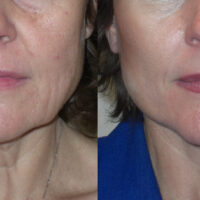 Encore Facelift - Before and After Client 5