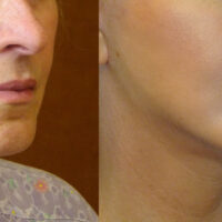 Encore Facelift - Before and After Client 6