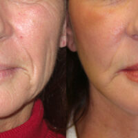 Encore Facelift - Before and After Client 7