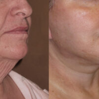 Encore Facelift - Before and After Client 8