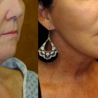Encore Facelift - Before and After Client 9