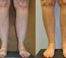 Surface Medical Spas Smarter Liposuction - before and after client 5