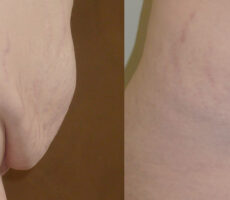 Surface Medical Spas Smarter Liposuction - before and after client 6