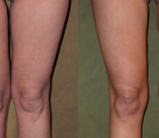 Surface Medical Spas Smarter Liposuction - before and after client 8