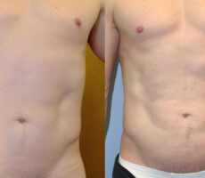 Surface Medical Spas Smarter Liposuction - before and after client 9
