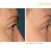 ultherapy-000k-004y_before-30daysafter_brow