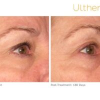 ultherapy-0013dlh_before-180daysafter_brow