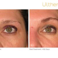 ultherapy-0030j-m_before-450daysafter_brow