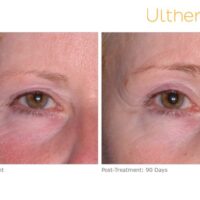 ultherapy-mrn22_before-90daysafter_brow