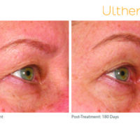 ultherapy_0196d-w_beforeandafter_brow_low-res