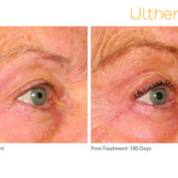 ultherapy_0197c-d_beforeandafter_brow1_low-res