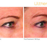 ultherapy_0221k-m_beforeandafter_brow_low-res